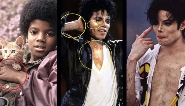 Michael-developing-vitiligo.webp Michael-developing-vitiligo.webp